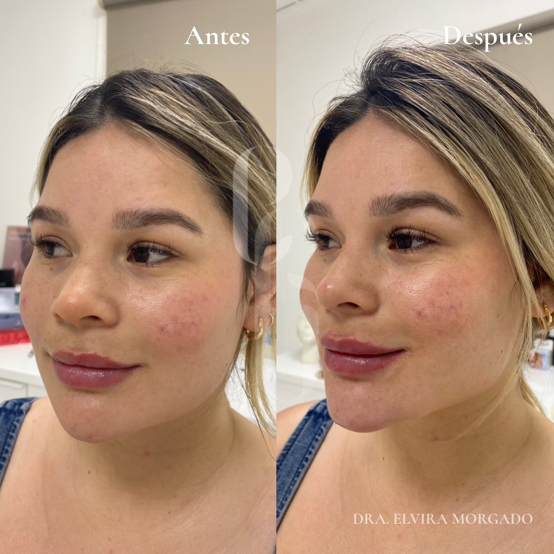 ARMONIZACION FACIAL (FULL FACE) - Clinica Esmeralda Gallego
