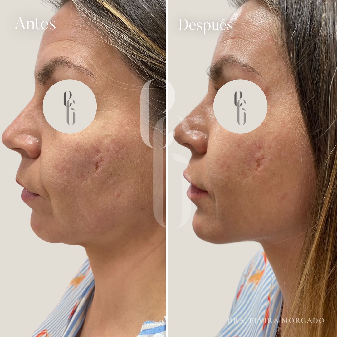 MARCACION MANDIBULAR - clinica esmeralda gallego