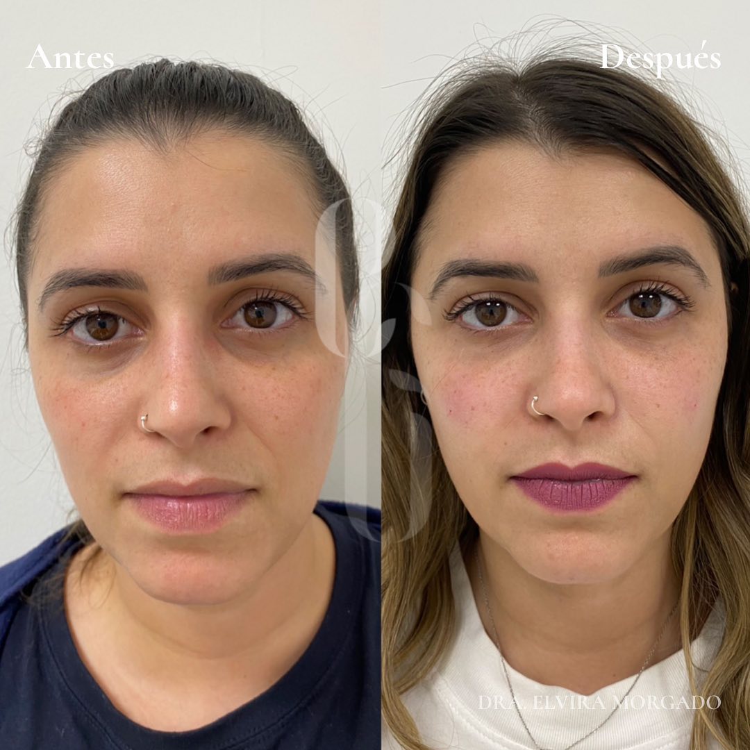 Tratamiento de ojeras - Clinica Esmeralda Gallego